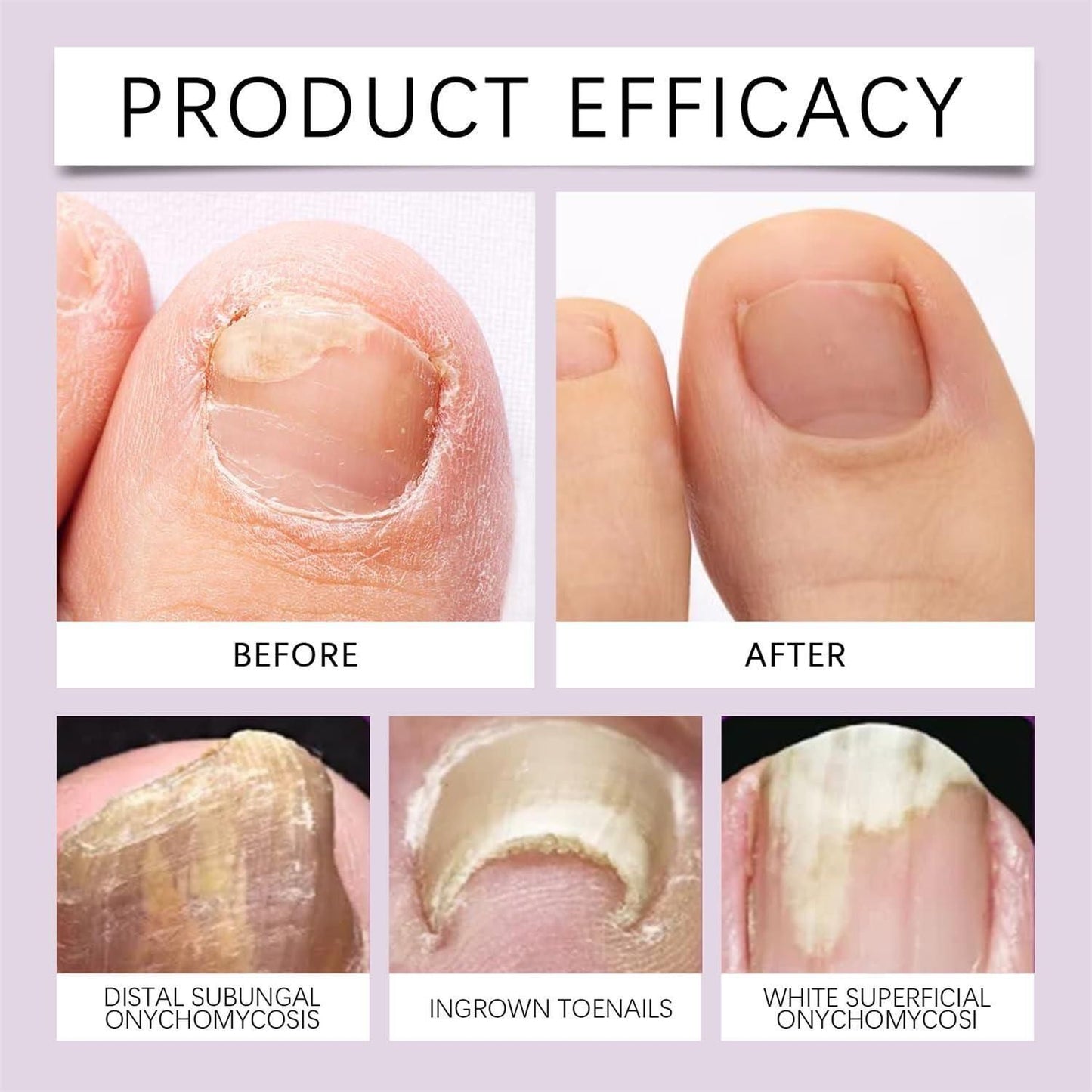 NailRevive – Nail Repair Serum (BUY 1 GET 1 FREE)